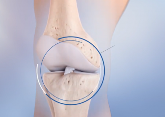 译文 | 更温和的方式来修复损伤 – ACL修复