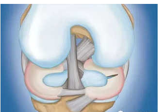半月板损伤是不可逆损伤吗？