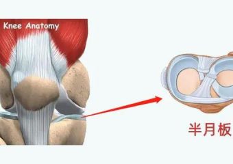 什么是半月板损伤