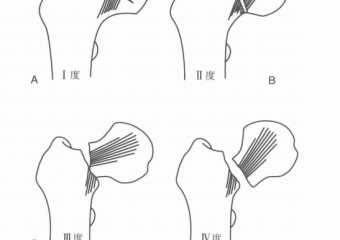 股骨颈骨折术后康复实例