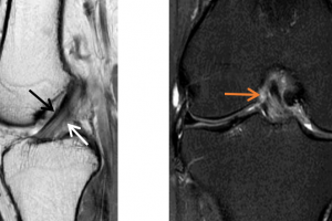 普通人如何看懂核磁？几个案例带你入门