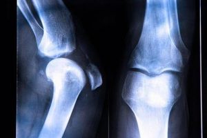 前交叉韧带重建的风险有哪些？