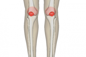 年轻人膝关节痛，当心是髌股疼痛综合征