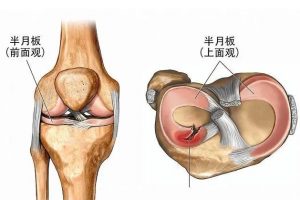 半月板损伤带有积液怎么办？我们需要加强膝关节的保护