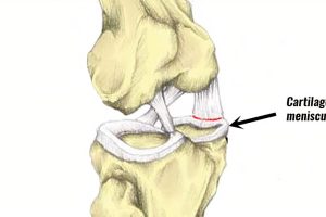 半月板损伤能自愈吗？