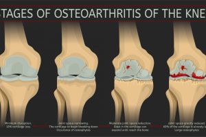 如何判断是否得了膝关节炎？