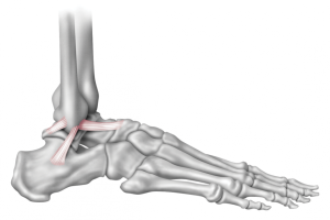 脚踝的秘密：从轻度扭伤到习惯性崴脚（下）