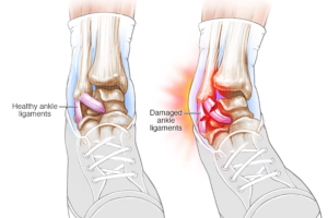 如何避免运动中的踝关节受损？