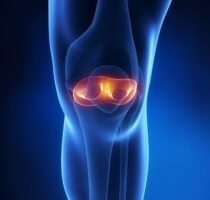 常见运动与半月板损伤：如何减少风险？