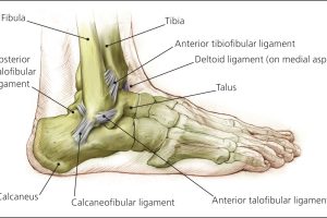 如何应对距腓前韧带断裂带来的生活与运动限制？