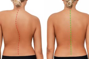 孩子高低肩、背部不对称?家长要警惕青少年脊柱侧弯!